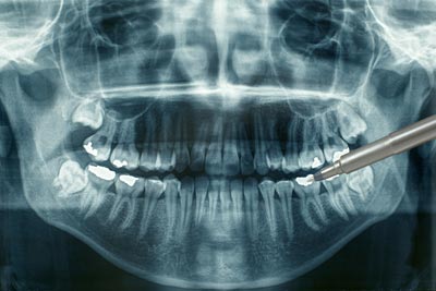 Dental X-Rays